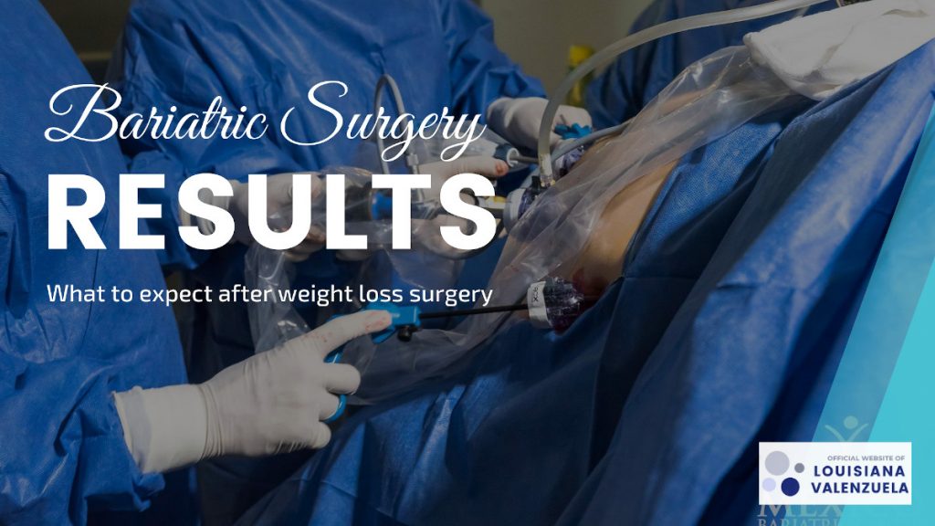 Bariatric Surgery Results - What to Expect