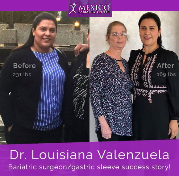Dr Louisiana Valenzuela Before and After Bariatric Photo