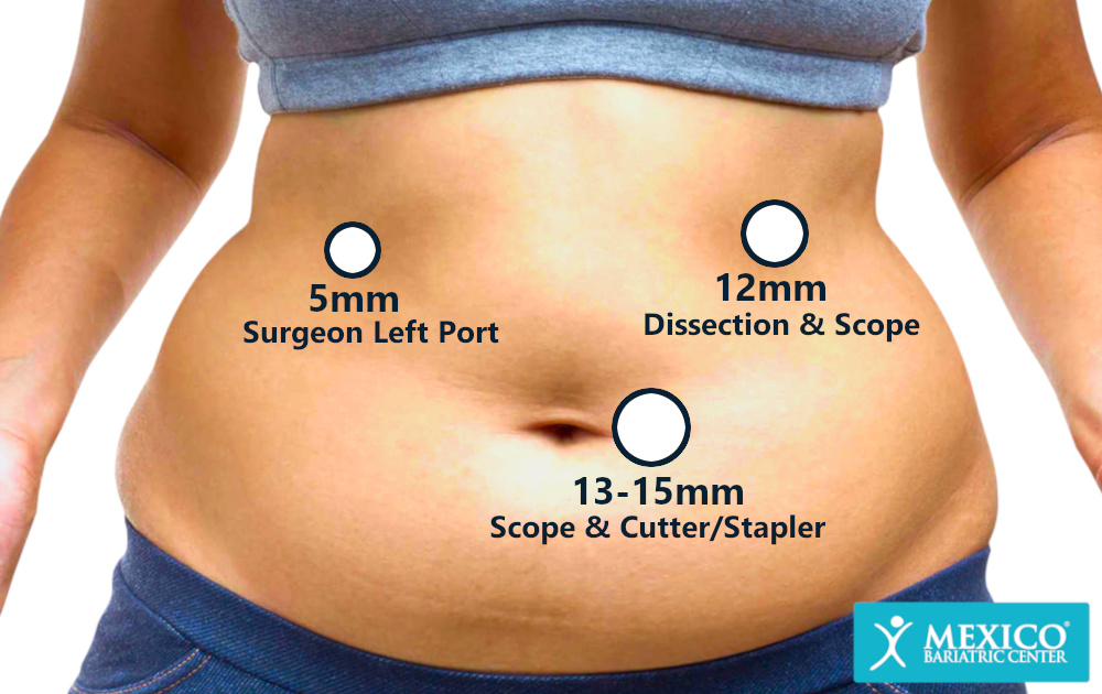 Gastric Sleeve Incisions - Laparoscopic Surgery Incisions After Vertical Sleeve Gastrectomy