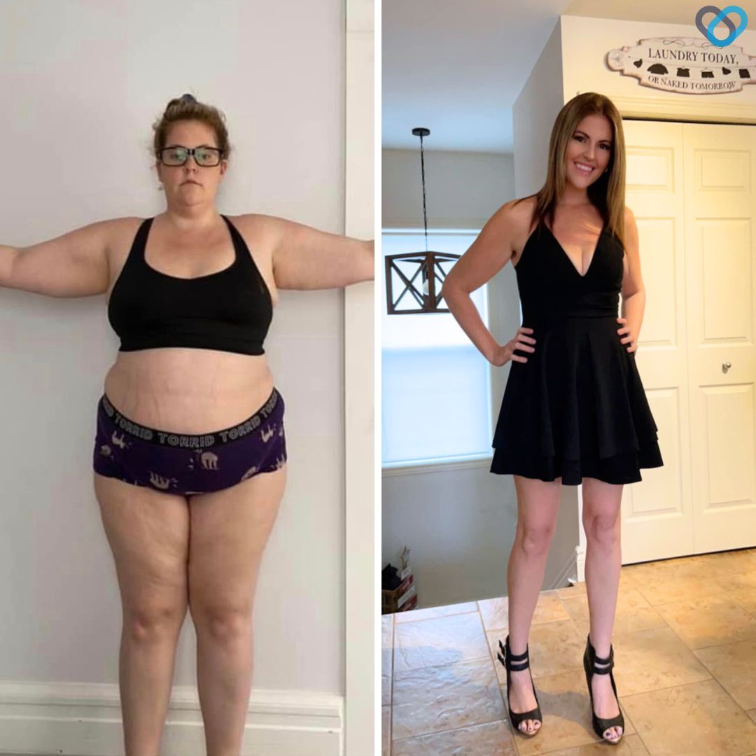 Alyssa Before and After Gastric Sleeve