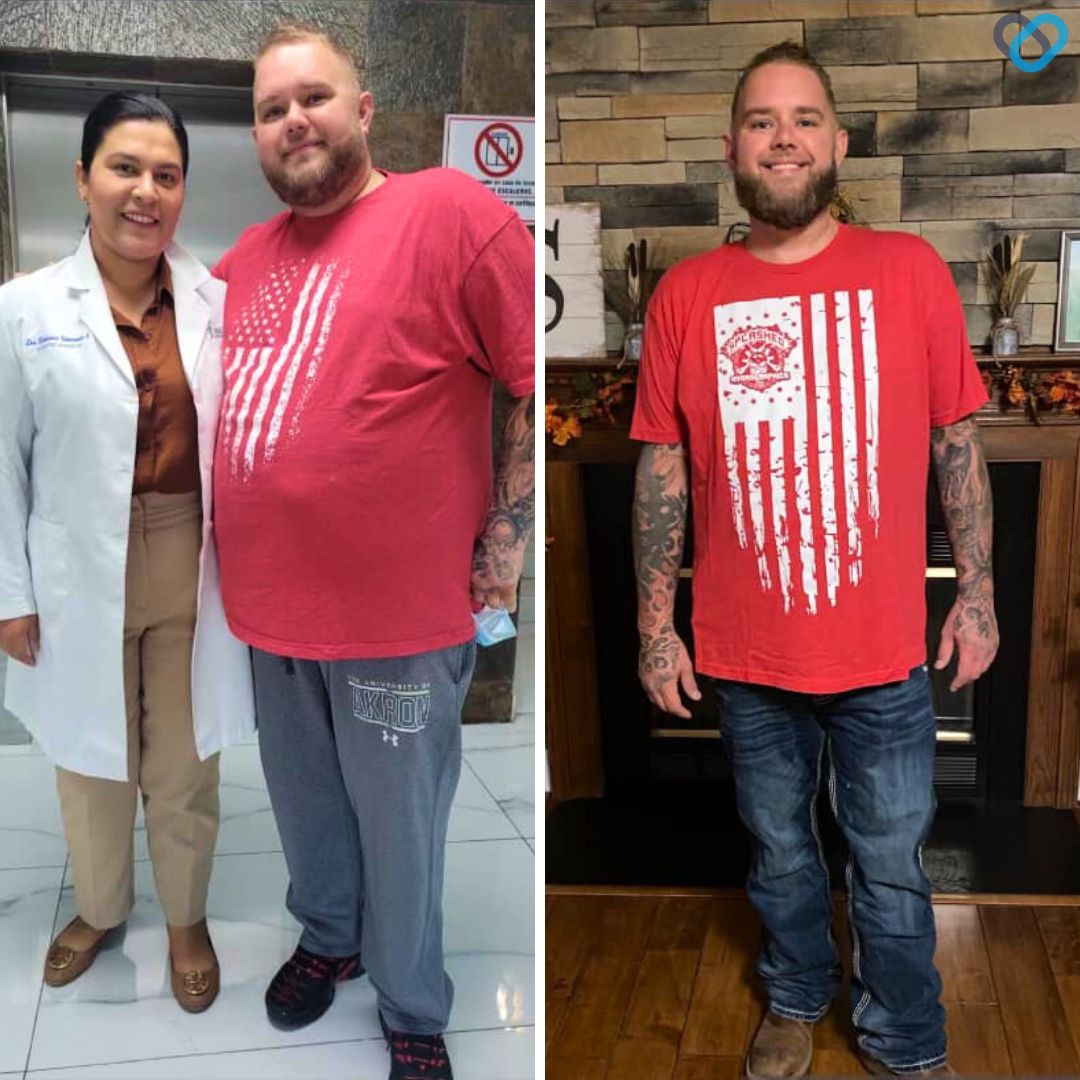Jay S Before and After Gastric Sleeve