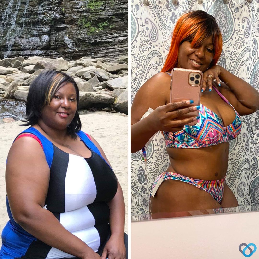 Kimberly E Before and After Gastric Sleeve