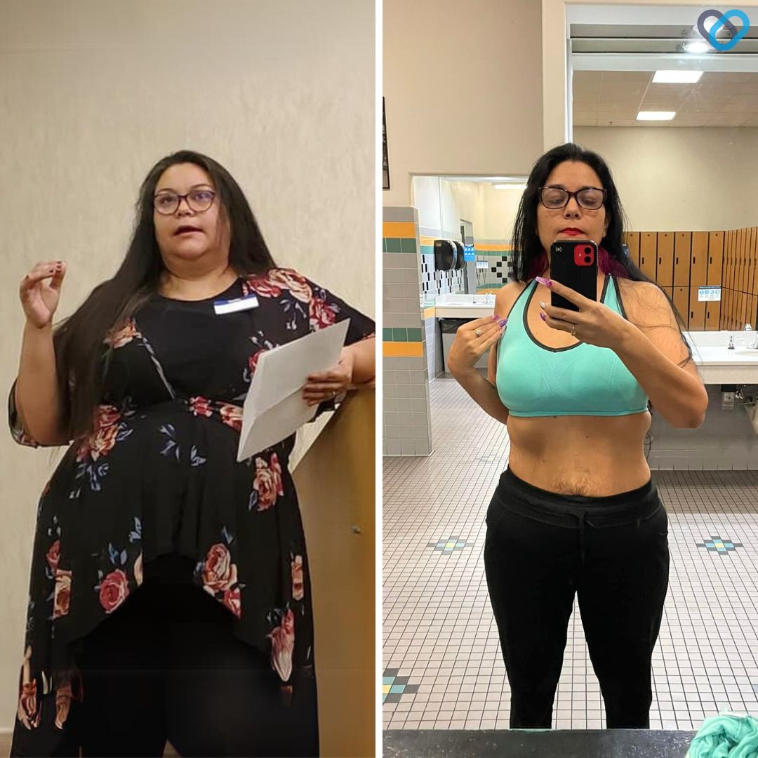 Marie S Before and After Gastric Sleeve