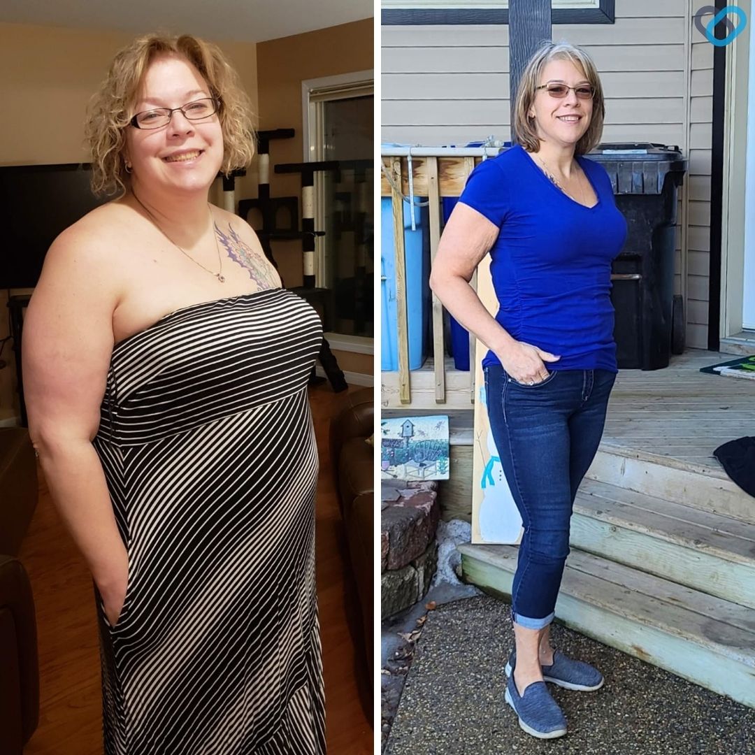 Robin M Before and After Gastric Sleeve