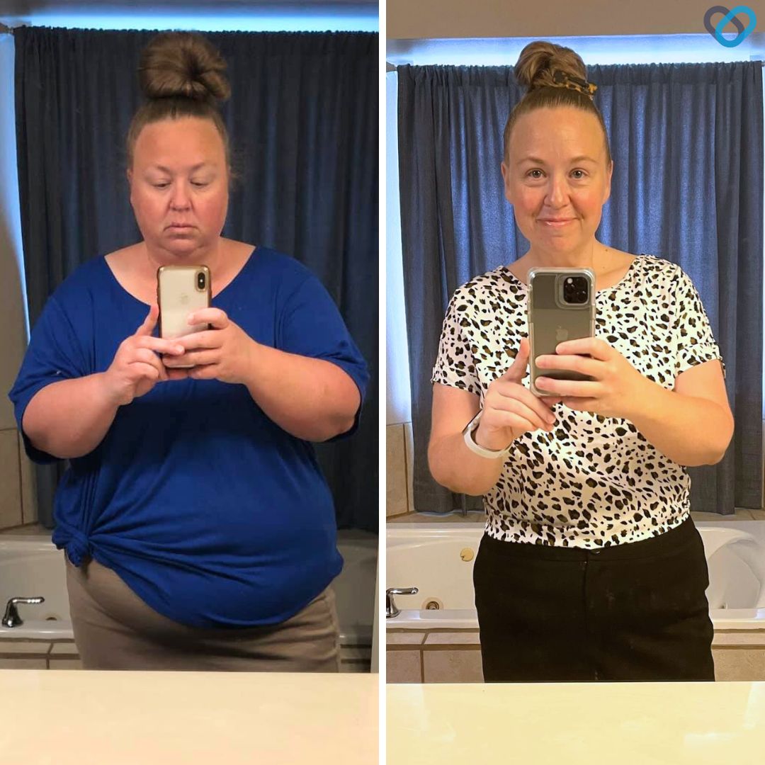 Ruth T Before and After Gastric Sleeve