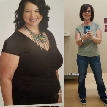 Sandra Gastric Sleeve Before and After